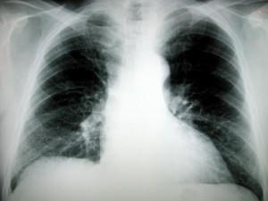肺がんの定位照射について